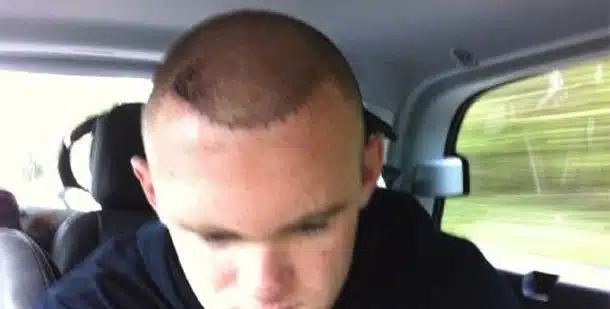 Wayne Rooney Hair Transplant Wayne Rooney Hair Transplant