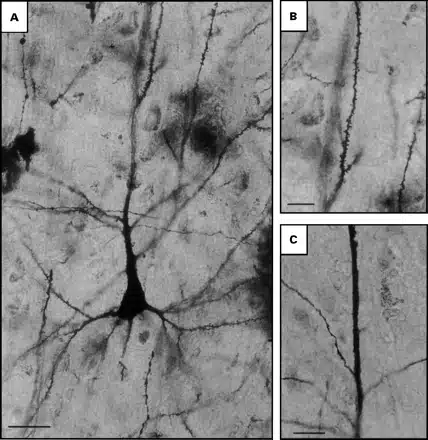 Golgi Stain Schizophrenic Brain Golgi Stain Schizophrenic Brain