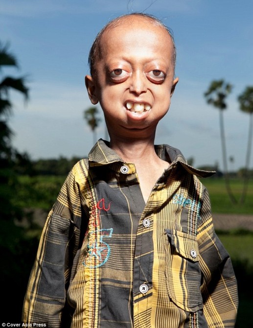 Progeria 2
