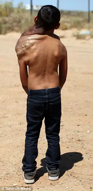 Kid Neck Tumour 3