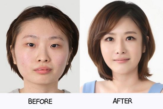 Crazy Before And After Photos Of South Korean Plastic Surgery Page