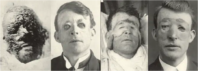 First Plastic Surgery - Harold Gillies - Walter Yeo
