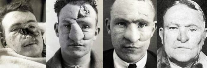 First Plastic Surgery - Harold Gillies - William M. Spreckley