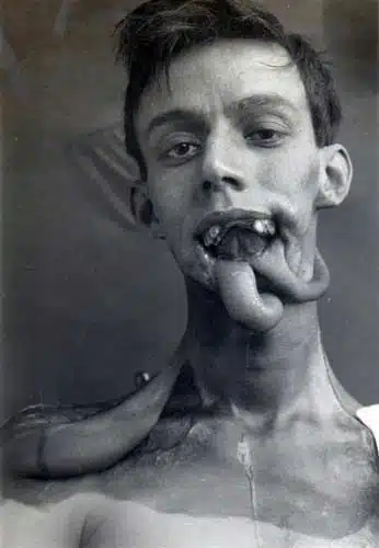 First Plastic Surgery - Harold Gillies - Willie Vicarage 2