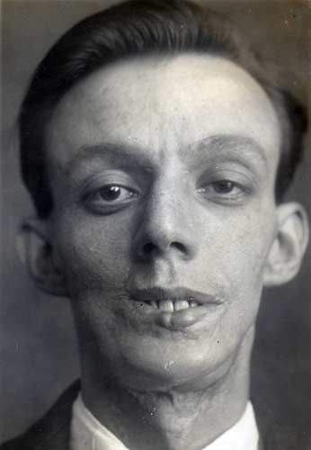 First Plastic Surgery - Harold Gillies - Willie Vicarage 4