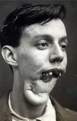 First Plastic Surgery - Harold Gillies - Willie Vicarage 5