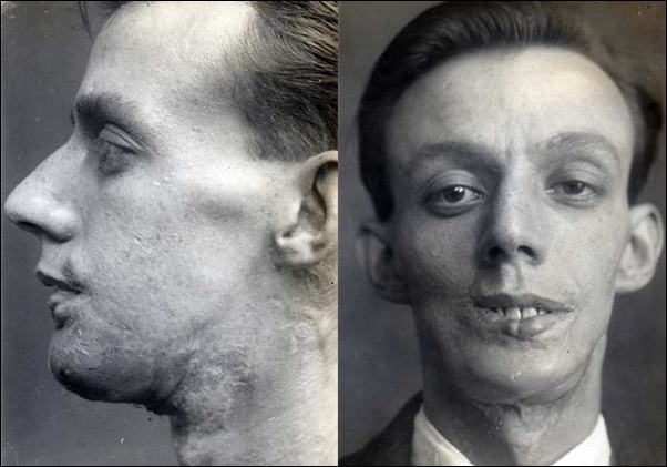 First Plastic Surgery - Harold Gillies - Willie Vicarage