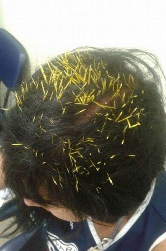 Weird News - Porucpine attack Brazil Sandra Nabucco