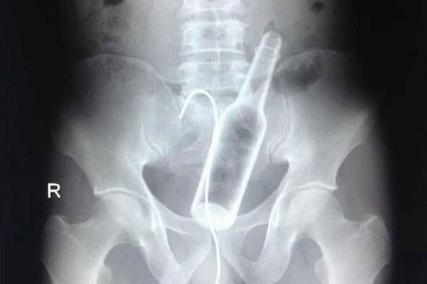 X-Ray-of-bottle-stuck-up-mans-bottom-3007510