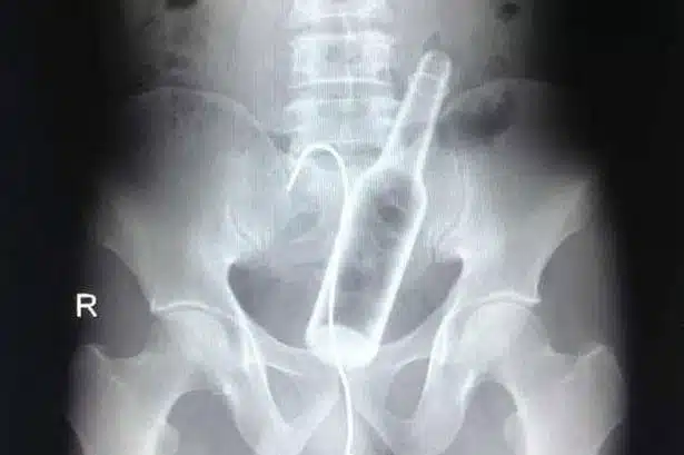 X-Ray-of-bottle-stuck-up-mans-bottom-3007510