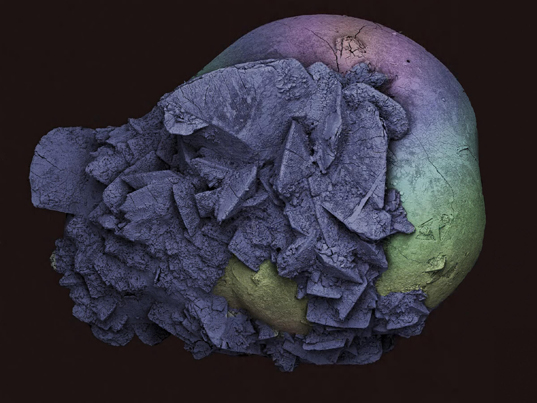 Wellcome Image Awards - Kidney stone