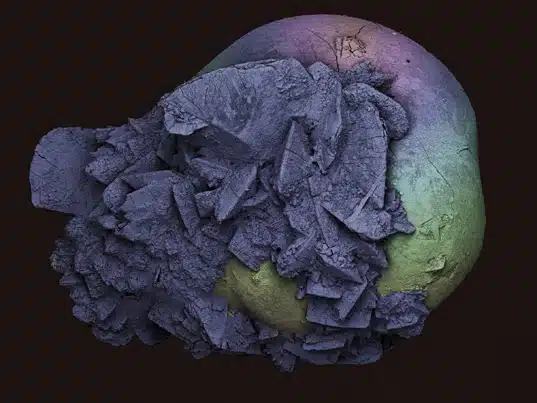 Wellcome Image Awards - Kidney stone
