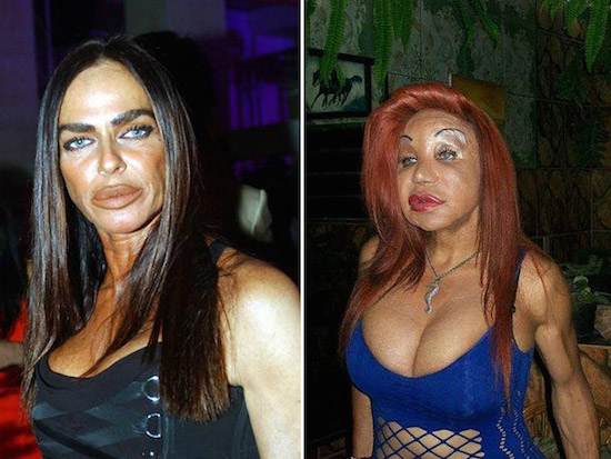 PLastic Surgery Gone Wrong 3
