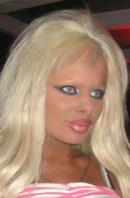 Plastic Surgery Gone Wrong 16