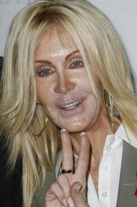 Plastic Surgery Gone Wrong 17