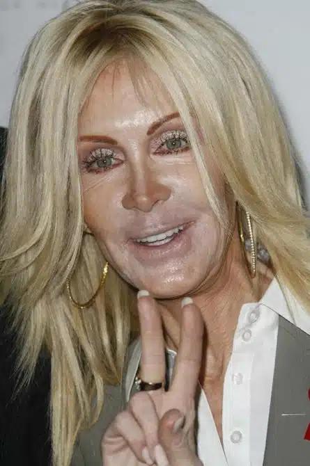 Plastic Surgery Gone Wrong 17
