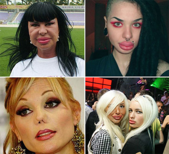 Plastic Surgery Gone Wrong 7