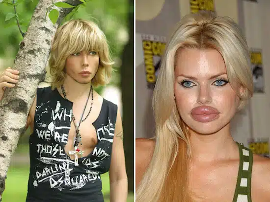 Plastic Surgery Gone Wrong 9