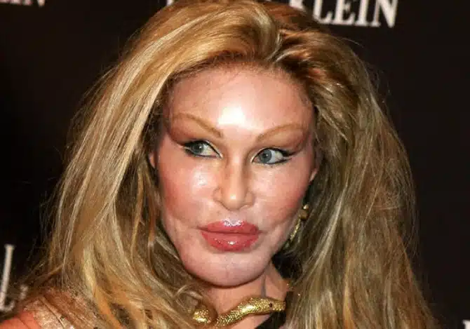 Jocelyn Wildenstein - why the lion face
