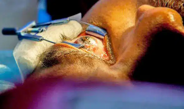 Eye Tattoo - Eyelid Pulled back