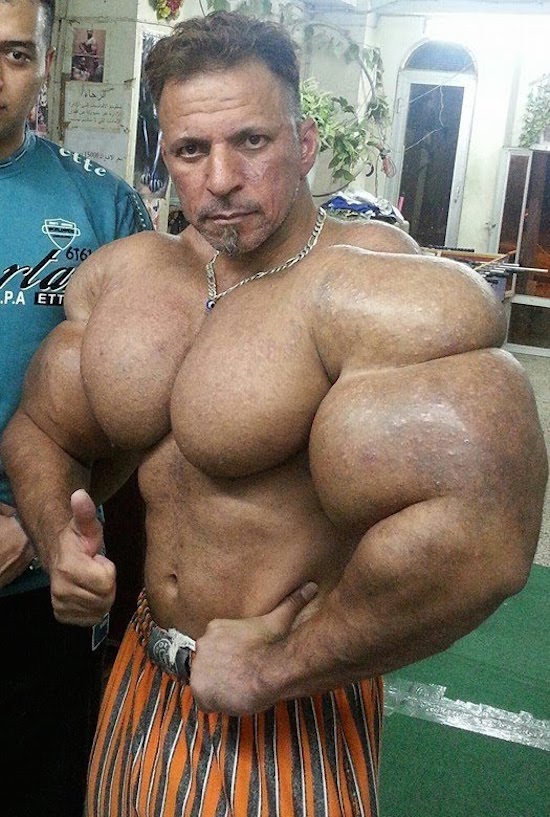 synthol and steroid bodybuilder 1