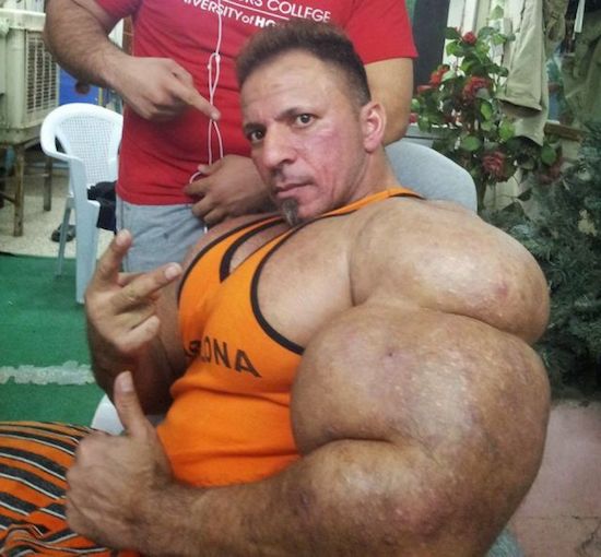 synthol and steroid bodybuilder 10