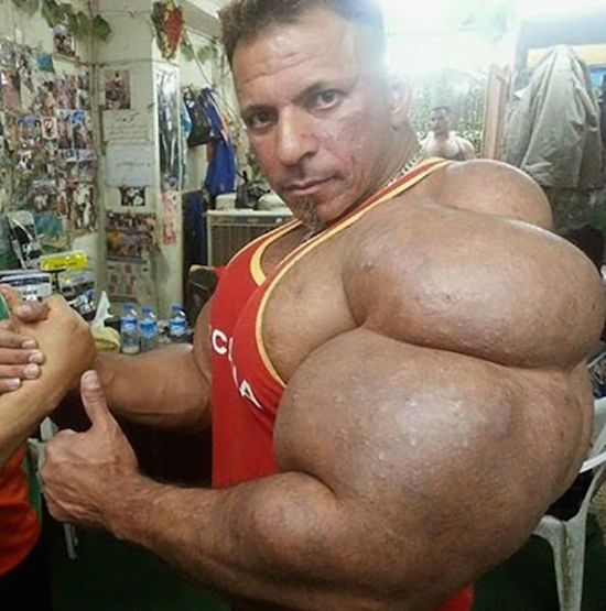synthol and steroid bodybuilder 11