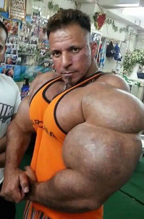 synthol and steroid bodybuilder 18