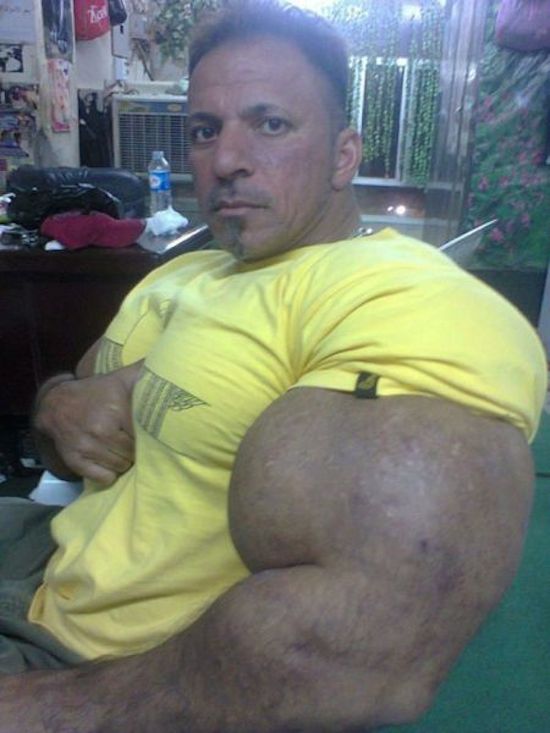 synthol and steroid bodybuilder 19
