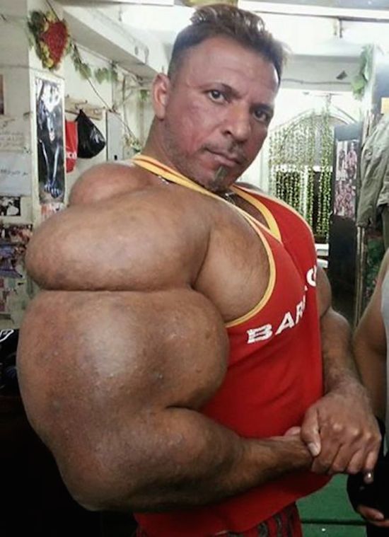synthol and steroid bodybuilder 5