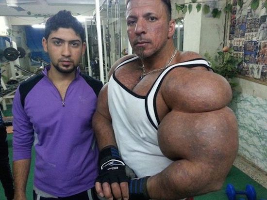 synthol and steroid bodybuilder 9
