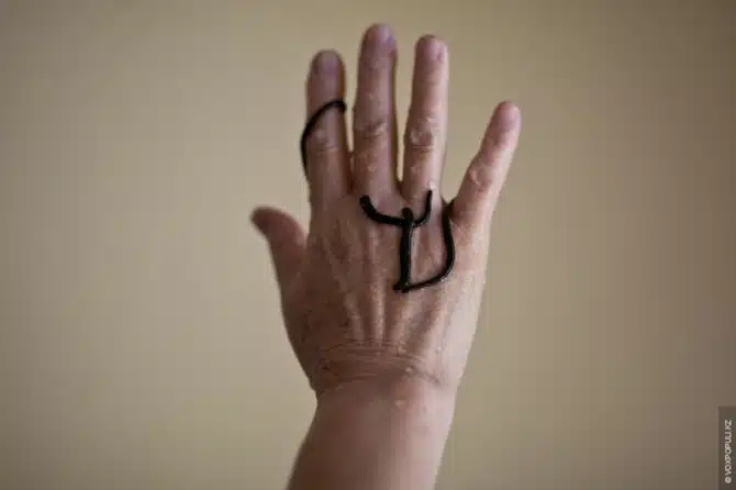 Alternative Therapy - leeches 2