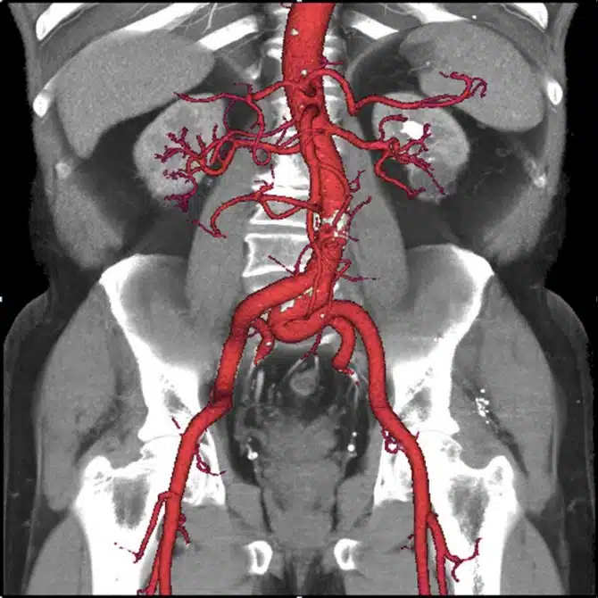 Revolution CT - Aorta