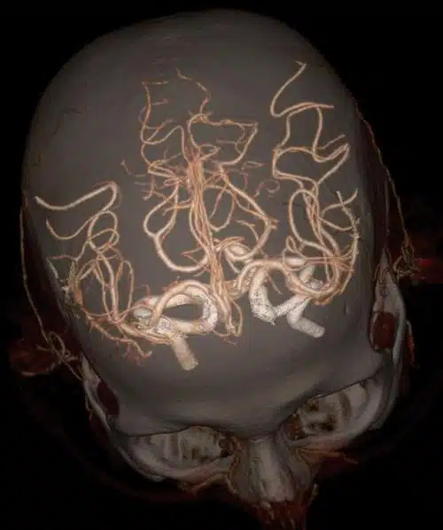 Revolution CT - Circle of Willis