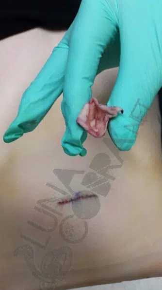 Belly Button Removal 2