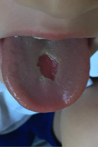 Burnt Tongue