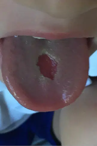 Burnt Tongue