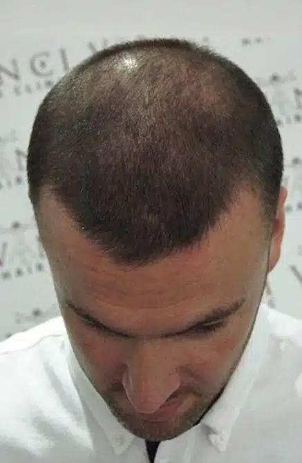 Tattooed Bald 3