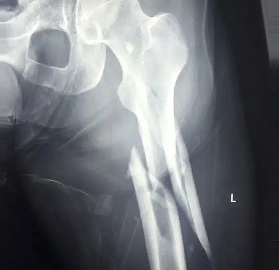 Leg Broken By Wave