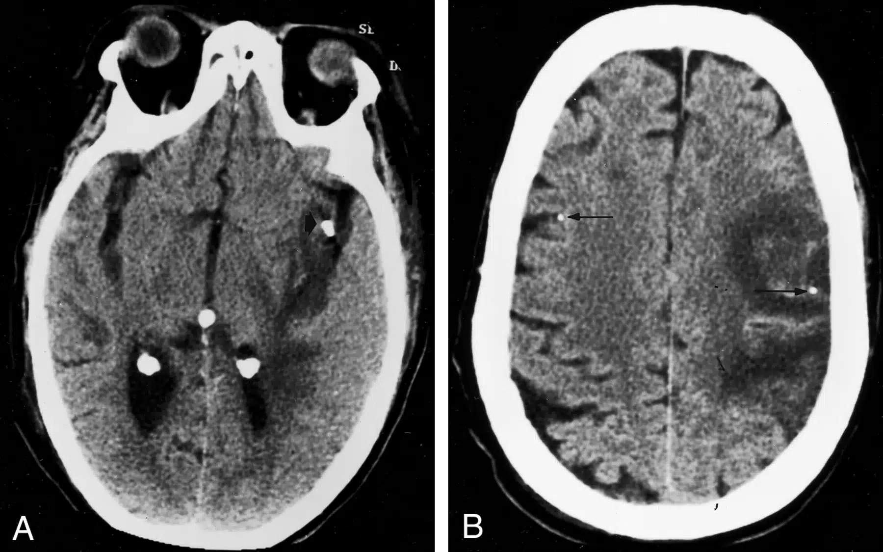 CAT Scan - Brain