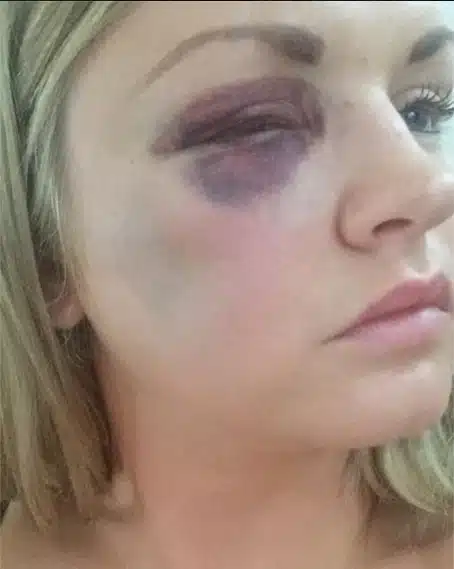 Samantha Dewar, from Macclesfield, was attacked by friend's groom on wedding day when she was bridesmaid