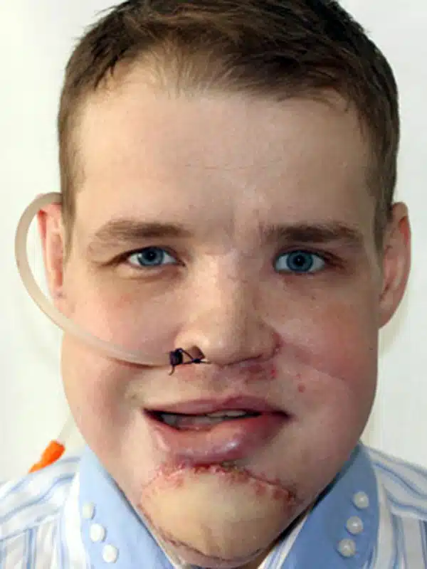 Pic shows: the reconstructed face of Aleksey Koptyakov. A man who thought he was going to die when he felt the bones in his head breaking as he was bitten by a bear has had his skull reconstructed with part of his pelvis. The horrific attack was later compared to the film 'Revenant' in which a bear horrendously mauled 29-year-old Alexei Koptyakov. He only escaped death when he passed out after a second mauling by the infuriated bear, and was so horrendously injured that several cars refused to stop after he had managed to crawl to a nearby road. He said: "I was walking back from a hunt when I heard my dog Thunder pickup a scent, and start barking. I thought it might be a bird and when I checked it out I found him standing outside a small cave. But inside there was a huge bear, and when it came out it went straight for me." He said that he had attempted to step backwards and slipped on the wet stone, with his gun going off in the process. He added: "I thought the sound would scare the bear off, but it actually made it even more angry and it came at me even faster. I tried to reload the gun, but by then it was already on me. I managed to get one blow at the bear hitting it with the gun, and then it sank its teeth into my head. "I tried to put my hands on my head, but it bit both of my hands and I couldn't use them after that to defend myself as it bit me on the head again. I curled into a ball, and could hear my bones cracking. That point I didn't expect to live any longer, I was hoping it would eat me quickly so I wouldn't suffer too much." He said however that the bear had been determined to apparently make him suffer, and continue to maul him for several minutes before then dropping him having extracted its revenge, and lumbering off into the forest. But seconds later it had rushed back out of the forest and attacked him again. He said it was difficult to remember much after that, but he remembers the bear leaving for the second time, and seeing the snow