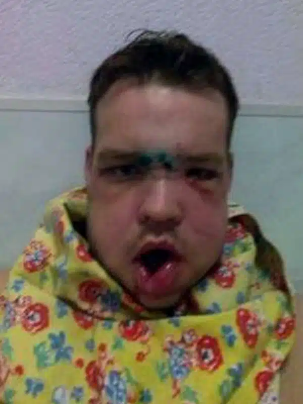 Pic shows: Aleksey Koptyakov after the bear attack. A man who thought he was going to die when he felt the bones in his head breaking as he was bitten by a bear has had his skull reconstructed with part of his pelvis. The horrific attack was later compared to the film 'Revenant' in which a bear horrendously mauled 29-year-old Alexei Koptyakov. He only escaped death when he passed out after a second mauling by the infuriated bear, and was so horrendously injured that several cars refused to stop after he had managed to crawl to a nearby road. He said: "I was walking back from a hunt when I heard my dog Thunder pickup a scent, and start barking. I thought it might be a bird and when I checked it out I found him standing outside a small cave. But inside there was a huge bear, and when it came out it went straight for me." He said that he had attempted to step backwards and slipped on the wet stone, with his gun going off in the process. He added: "I thought the sound would scare the bear off, but it actually made it even more angry and it came at me even faster. I tried to reload the gun, but by then it was already on me. I managed to get one blow at the bear hitting it with the gun, and then it sank its teeth into my head. "I tried to put my hands on my head, but it bit both of my hands and I couldn't use them after that to defend myself as it bit me on the head again. I curled into a ball, and could hear my bones cracking. That point I didn't expect to live any longer, I was hoping it would eat me quickly so I wouldn't suffer too much." He said however that the bear had been determined to apparently make him suffer, and continue to maul him for several minutes before then dropping him having extracted its revenge, and lumbering off into the forest. But seconds later it had rushed back out of the forest and attacked him again. He said it was difficult to remember much after that, but he remembers the bear leaving for the second time, and seeing the snow arou