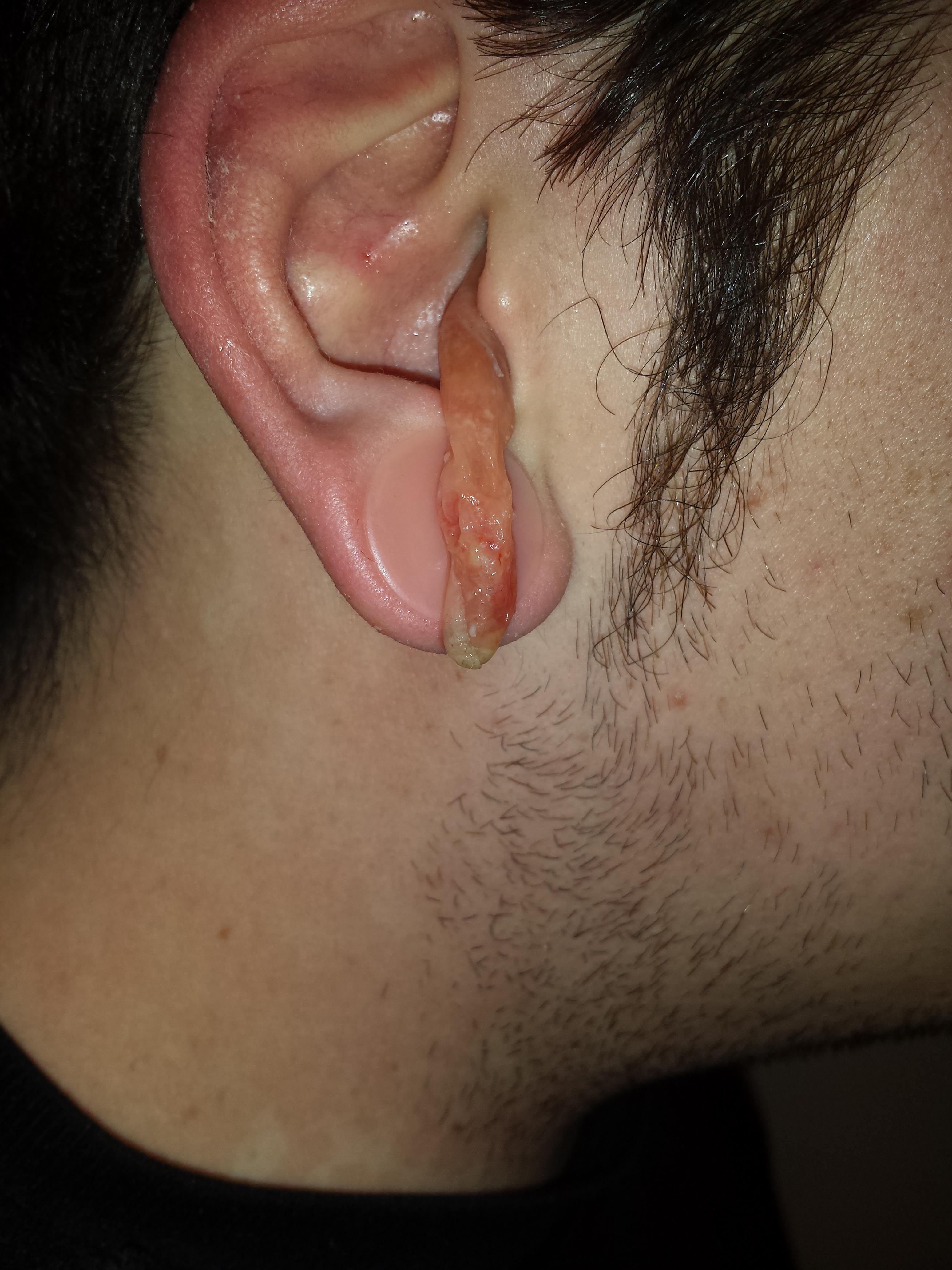 Ear Infection 10