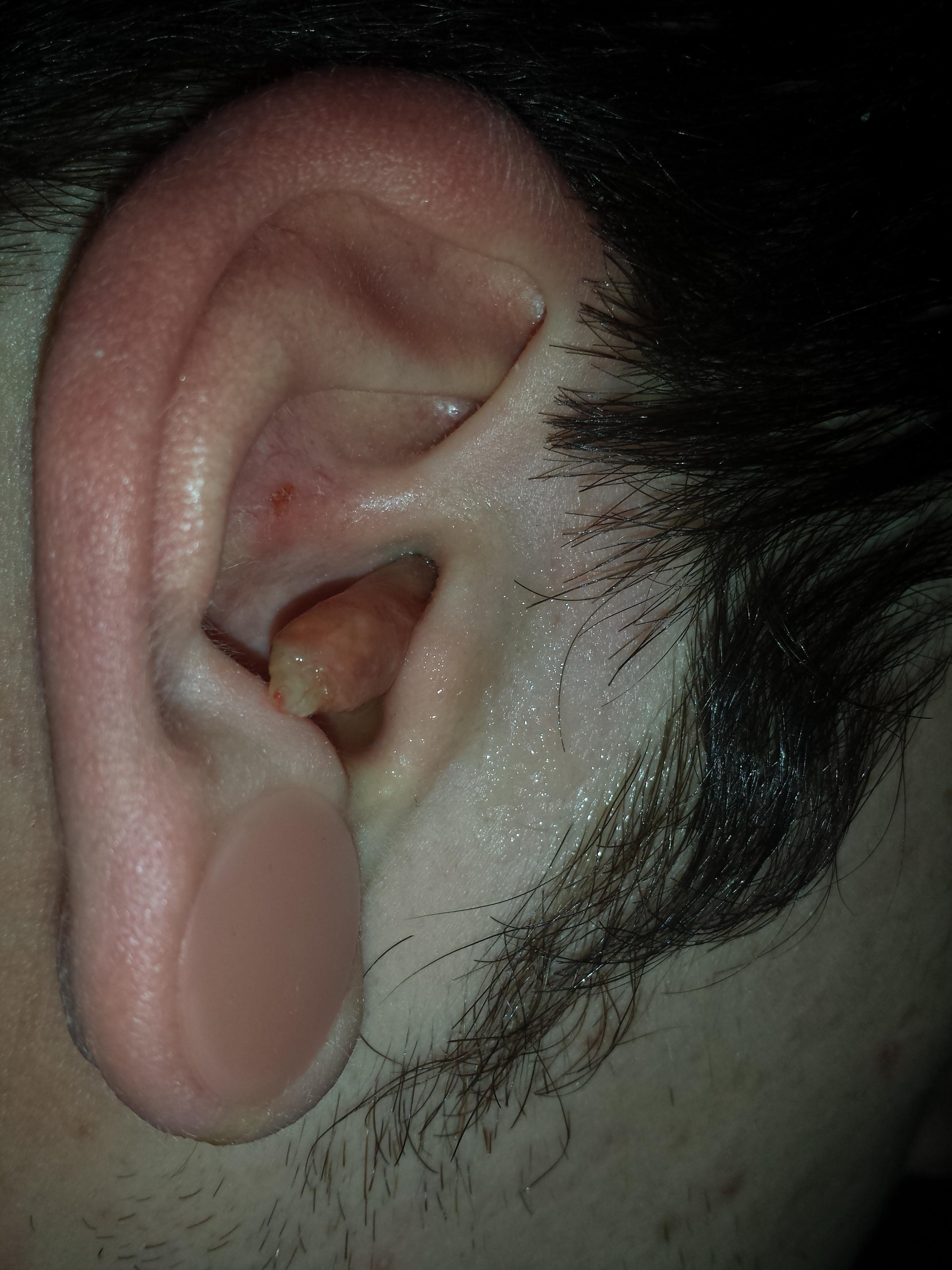 Ear Infection 2