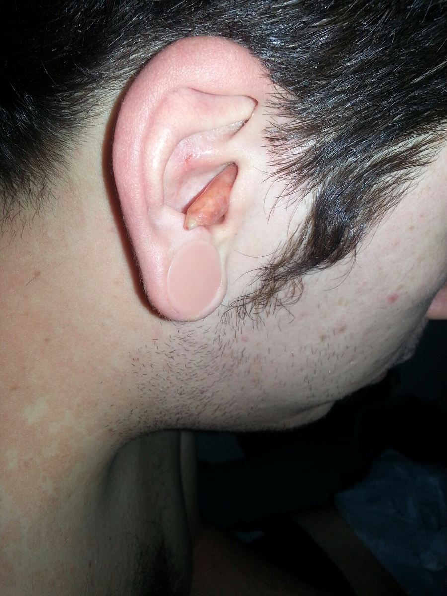 Ear Infection 3