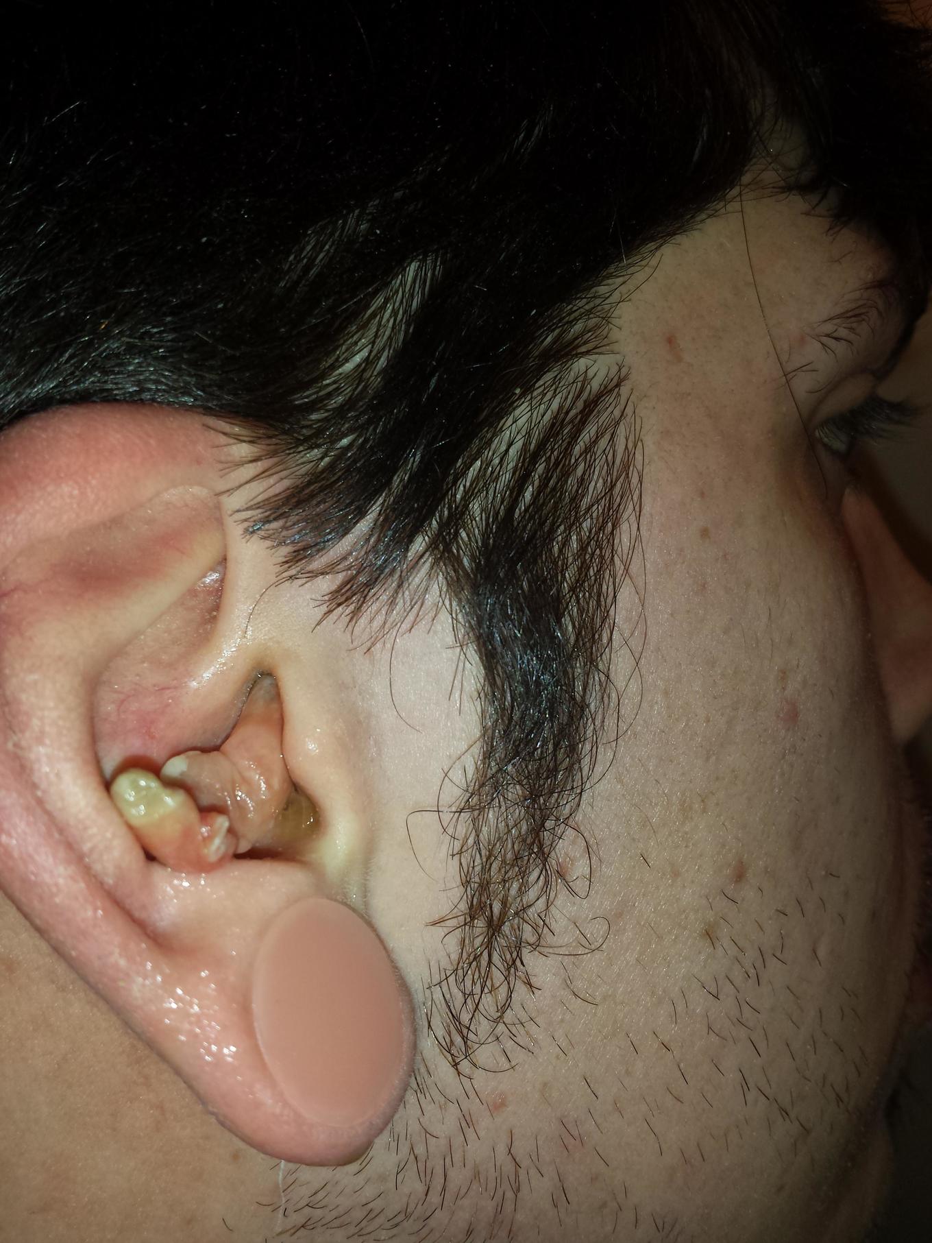 Ear Infection 8