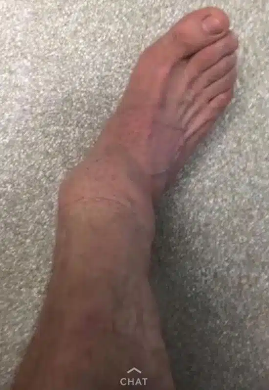 Steve-O Ankle