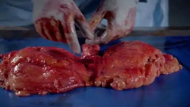 POST MORTEM ON A OBESE WOMAN - BBC BBC