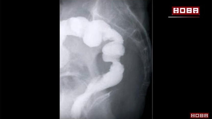 colon-vagina